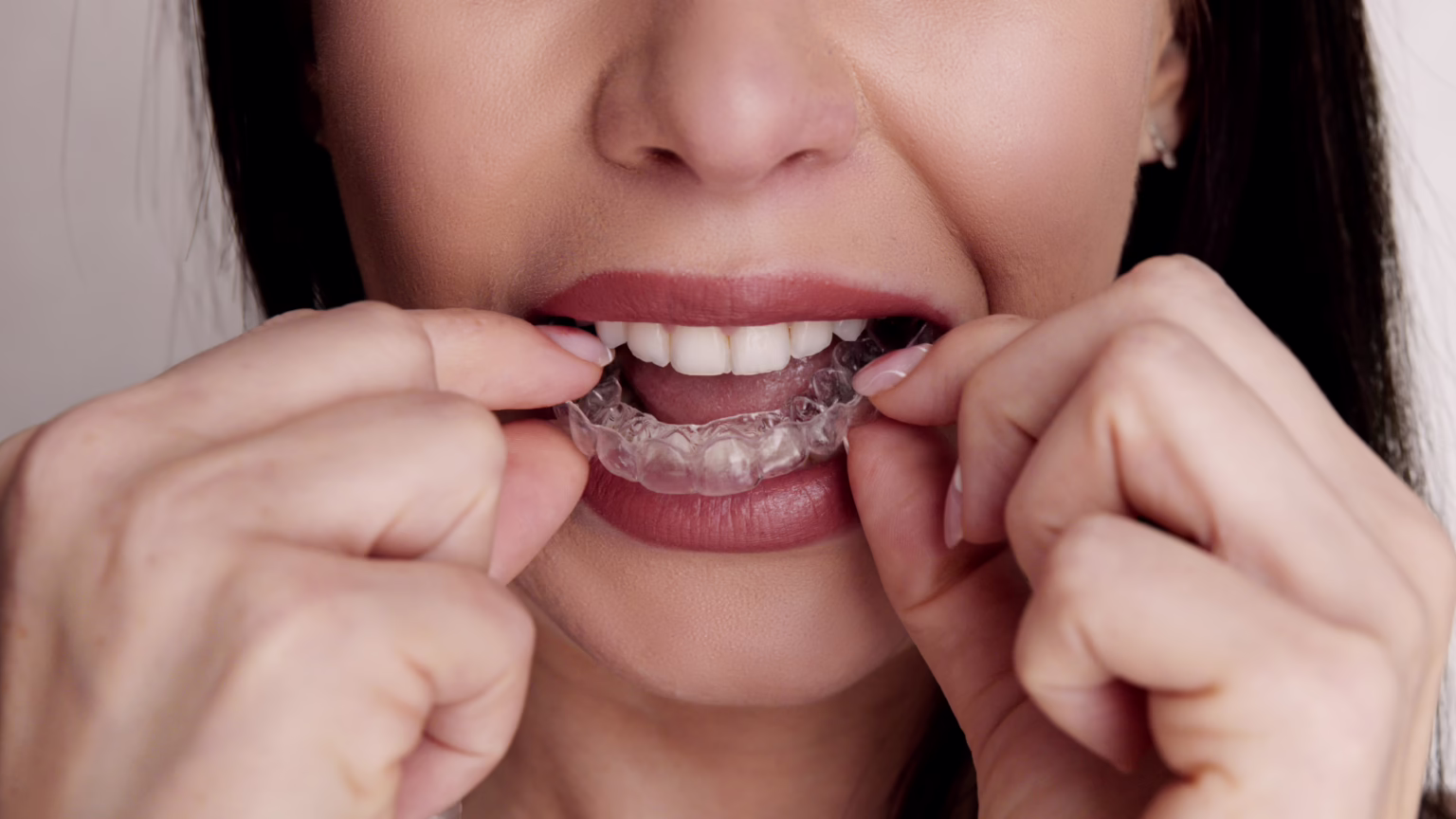 How to Fix a Crooked Smile Without Braces