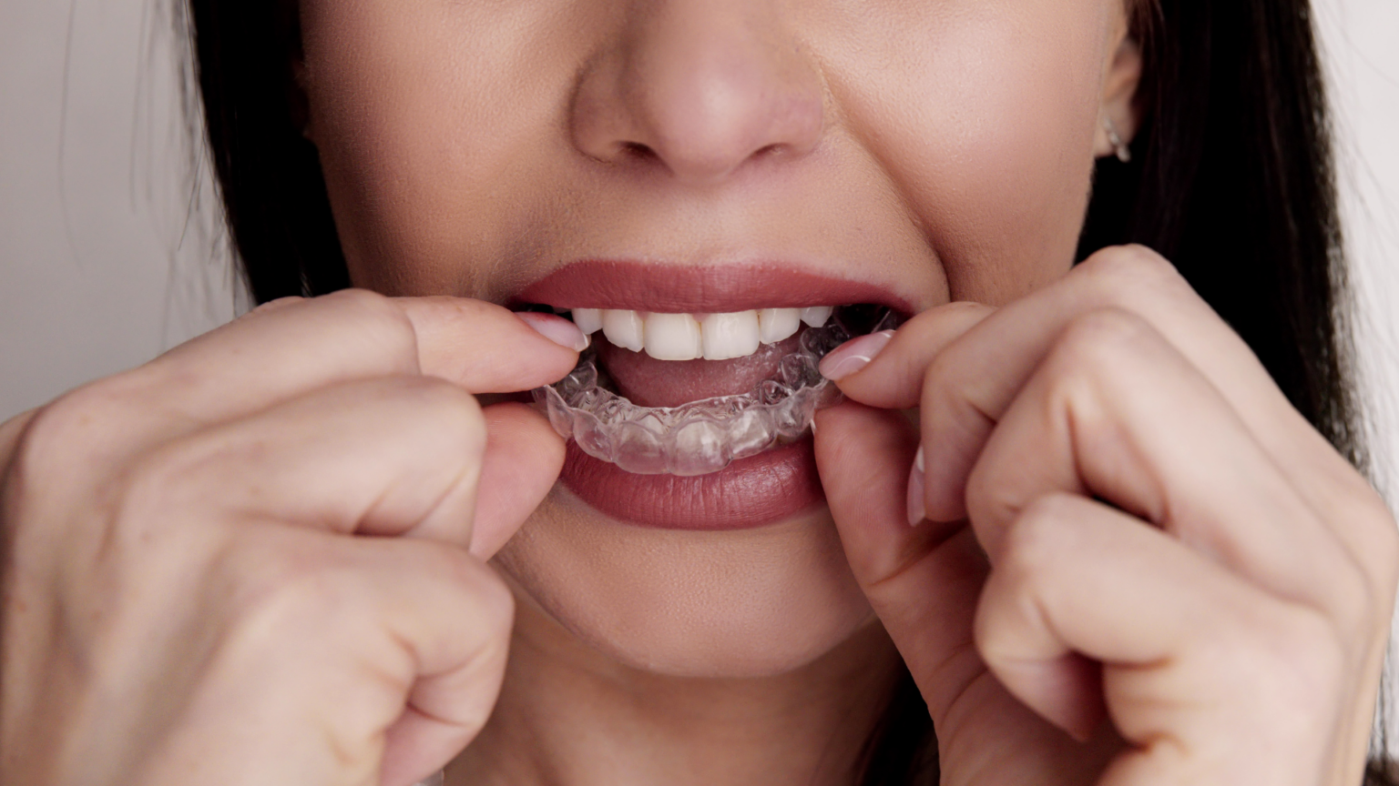 How to Fix a Crooked Smile Without Braces