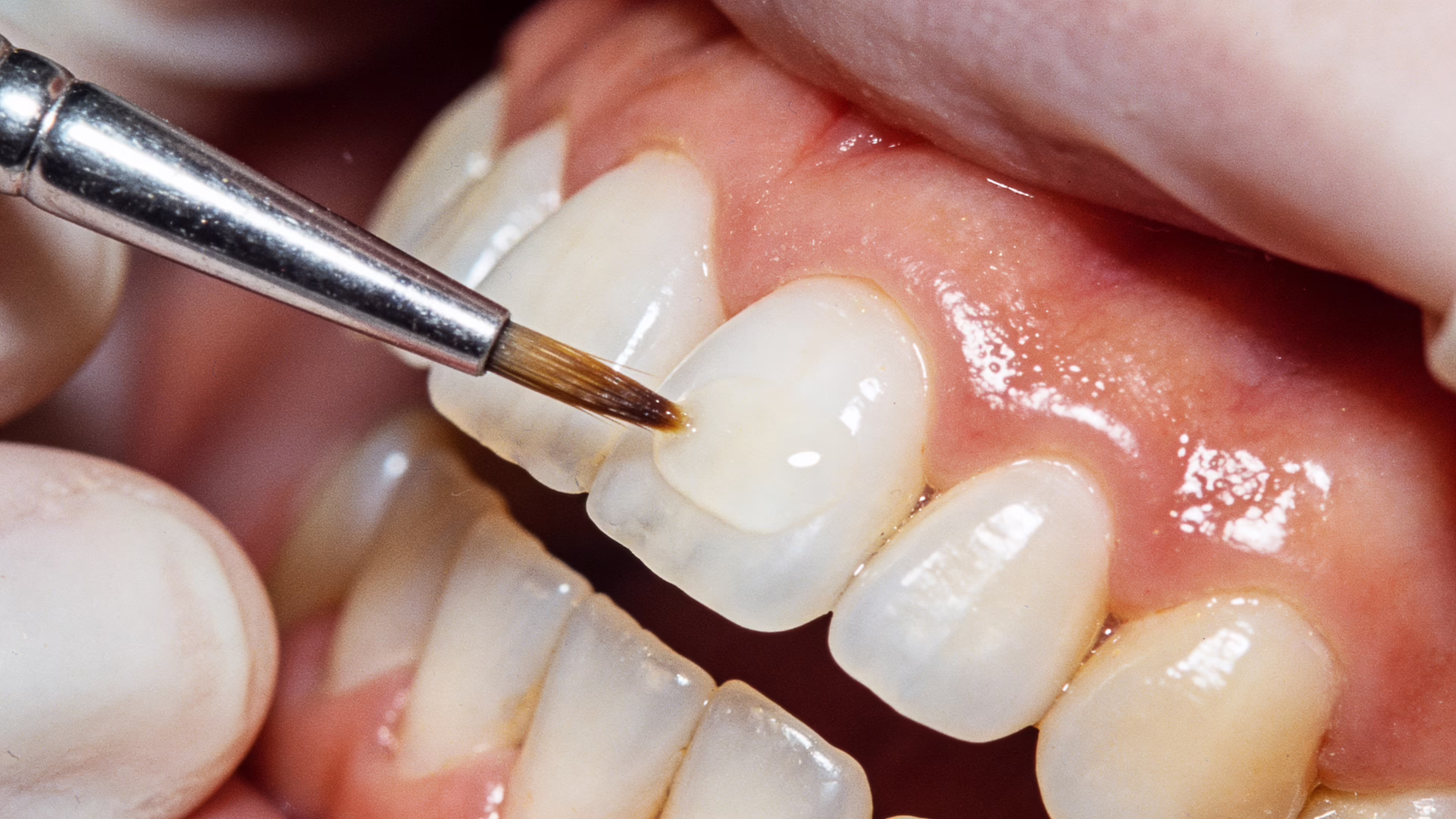 The Real Cost of Cosmetic Dentistry in Los Angeles